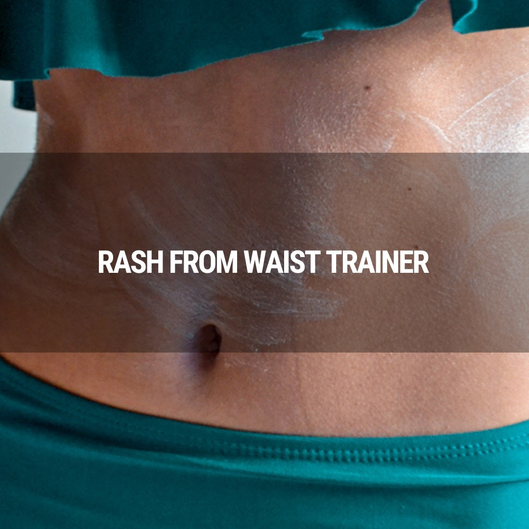 How to Get Rid of Rash from Waist Trainer?